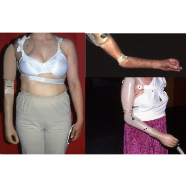 UTAH proportional control myoelectric transhumeral prosthesis